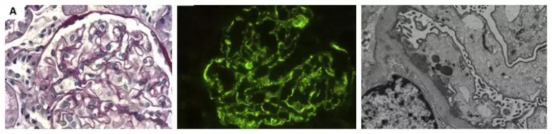 大量尿蛋白9克打单抗管用吗,尿蛋白9克多严重吗