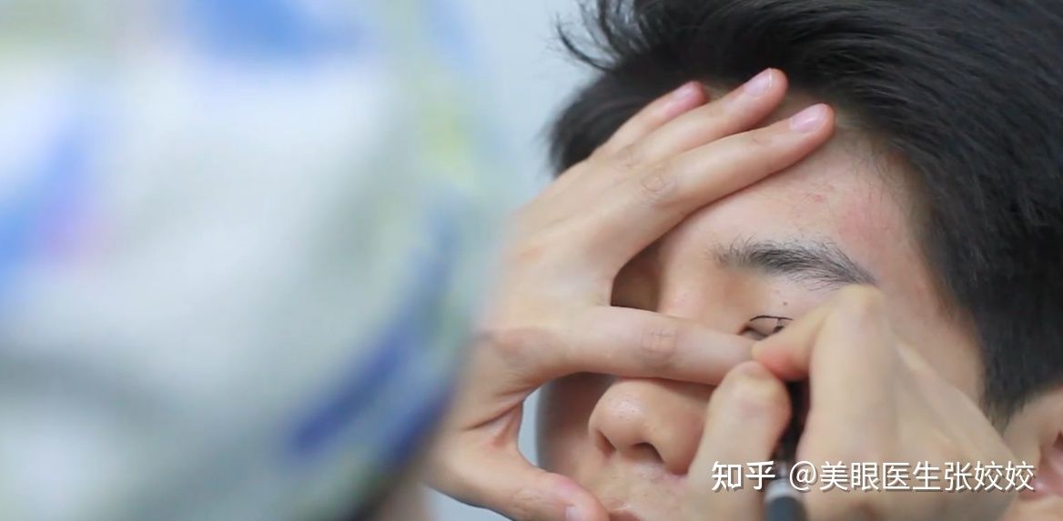 男生做双眼皮是全割还是埋线,男生肉眼泡双眼皮手术
