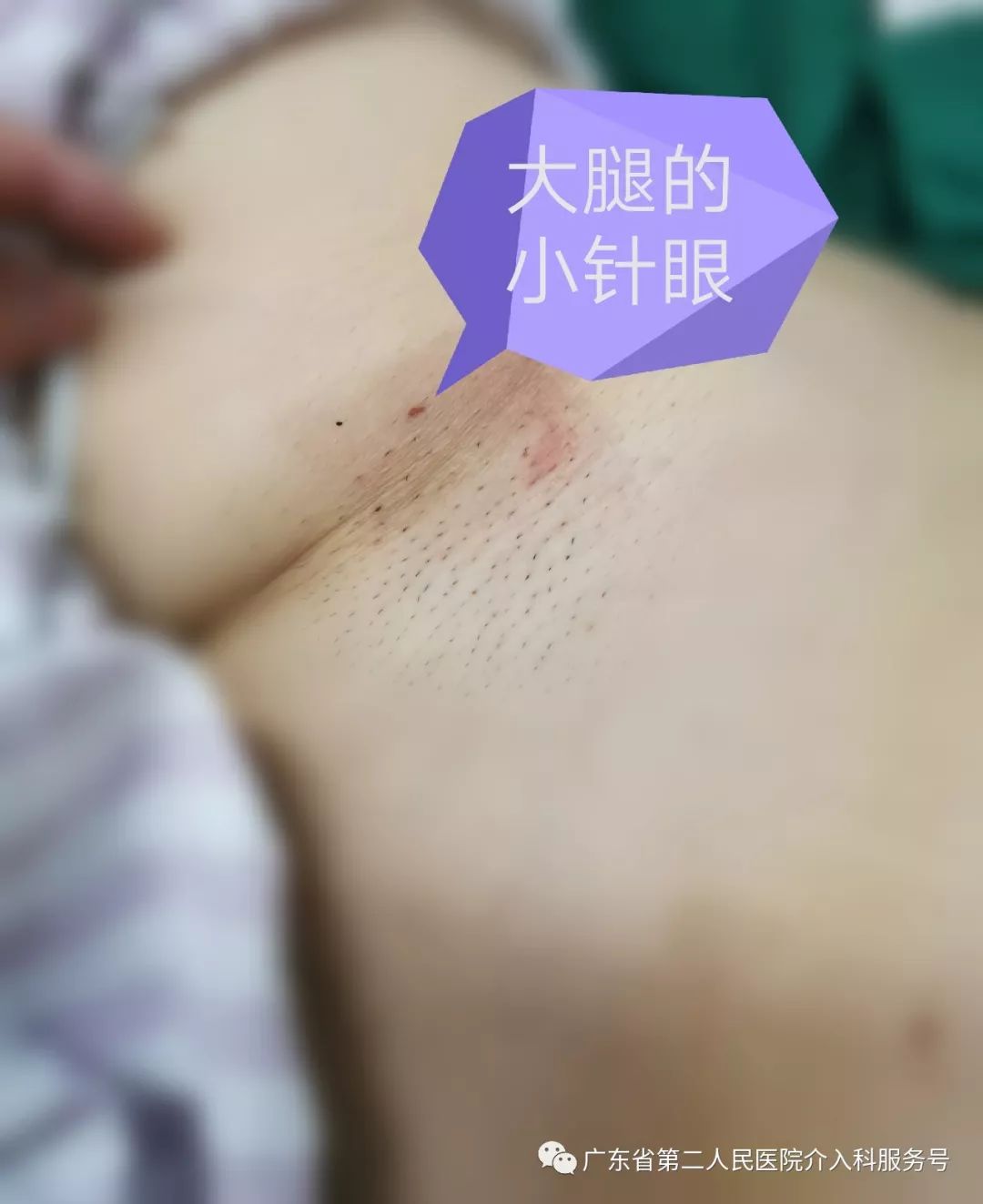 子宫多发肌瘤，月经量超多，重度贫血需输血，如何保宫治疗？