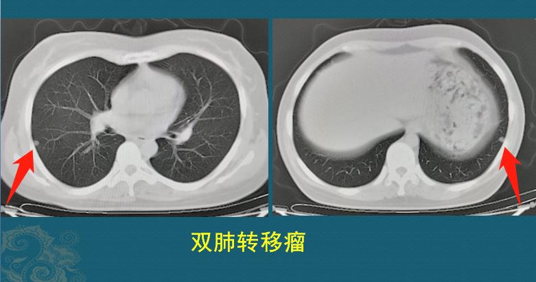 癌症晚期最好的治疗方案,癌症晚期最好的治疗方式