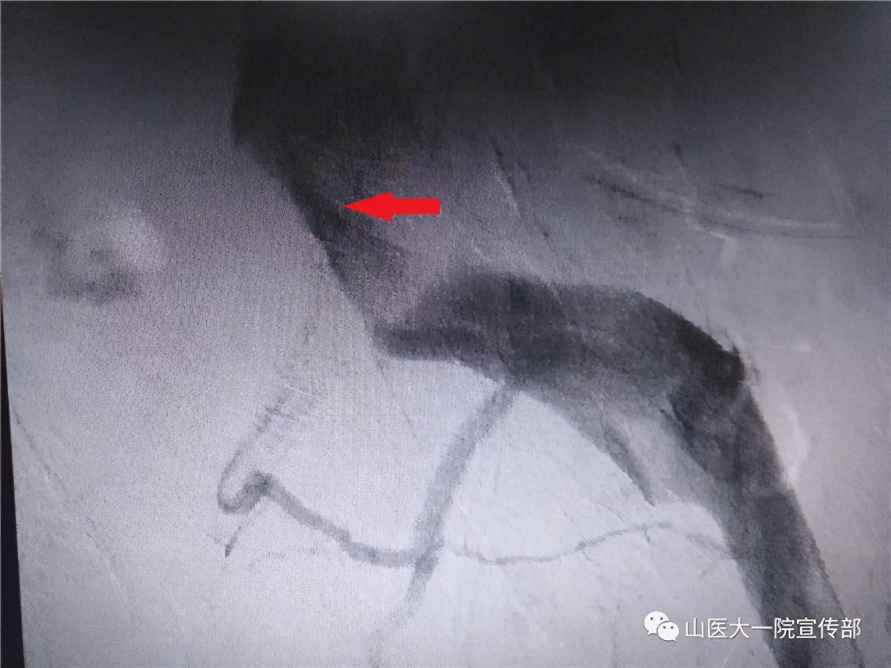 来山医大一院看病治好了十多年的*毛老**病