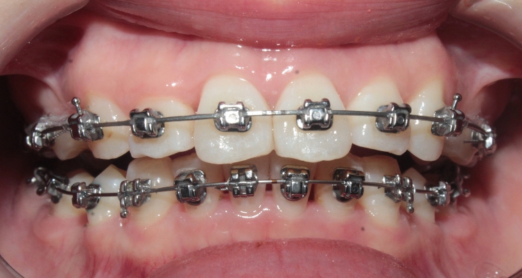 南京牙齿矫正内倾,南京牙齿矫正比较好的医院有哪些