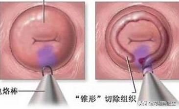 「免疫相关不良妊娠答疑解惑53」——宫颈机能不全