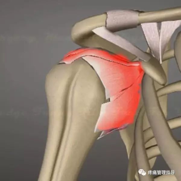 肩周炎的原因与锻炼方法