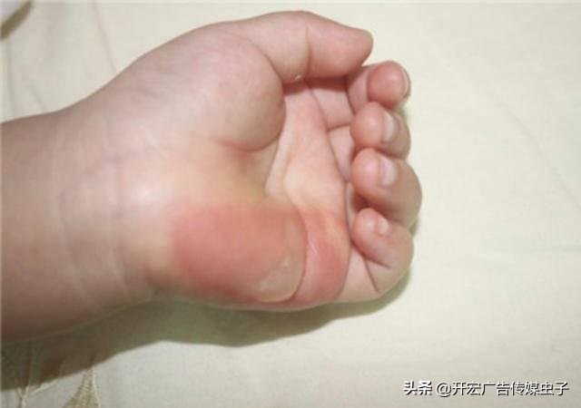 小孩烫伤起水泡要不要挑破,烫伤水泡反复鼓起要反复刺破吗