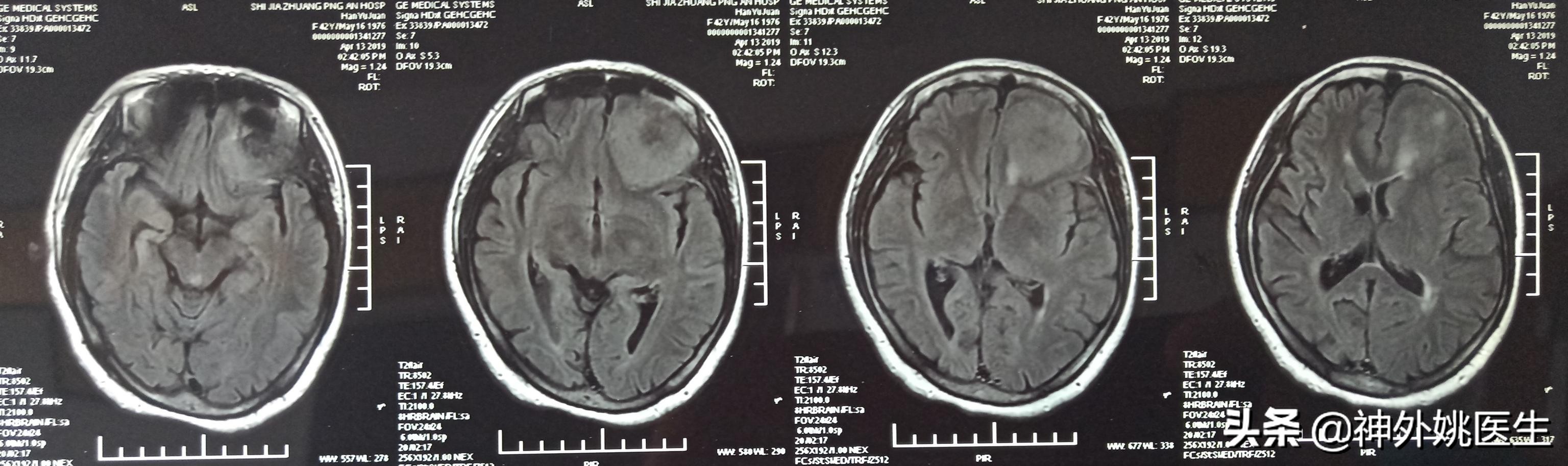 脑膜瘤是什么原因引起的啊,脑膜瘤手术治疗全部大概多少钱