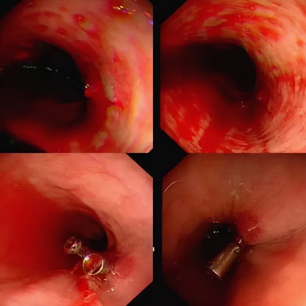 消化道出血止血利器——急诊胃镜下止血