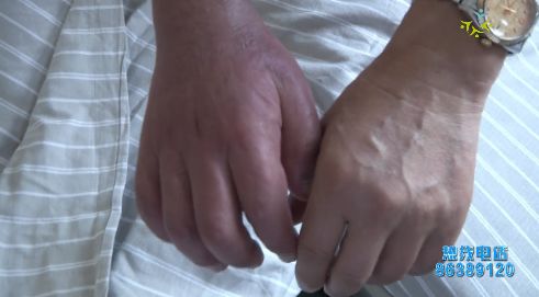 手部有肿胀的感觉,手指肿胀如何判断是风湿还是感染