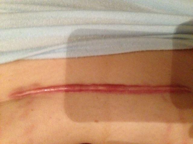 剖腹产后遗症疤痕憩室影响怀孕吗,剖腹产疤痕会给另一半造成阴影吗