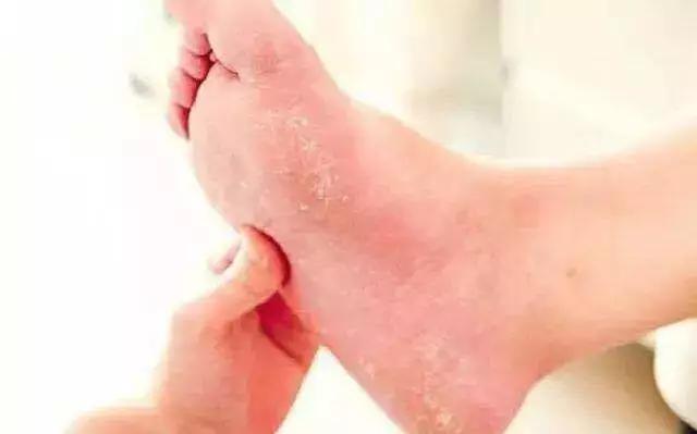 加拿大皲裂霜,加拿大修复膏