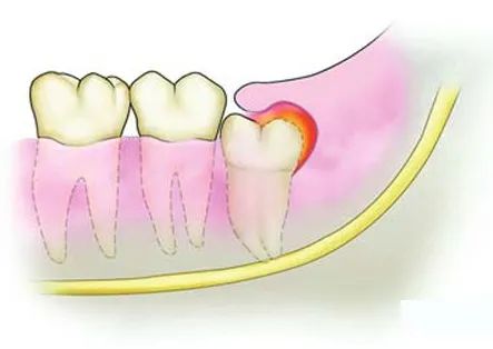 疫情期找不到口腔门诊看牙？这份居家牙病自救指南请查收