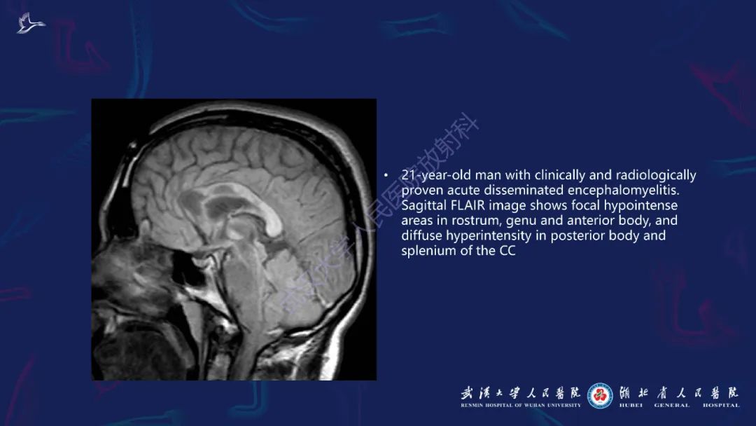 胼胝体肿瘤影像鉴别,胼胝体病变影像诊断