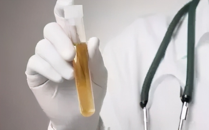 我的尿液是浓茶色怎么办,我的尿液有点微黄正常吗