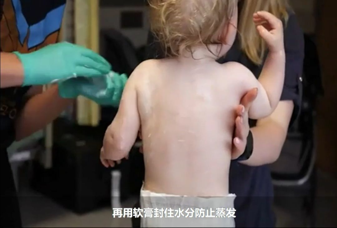 宝宝湿疹要注意保湿吗,儿童过敏性哮喘鼻炎湿疹怎么办