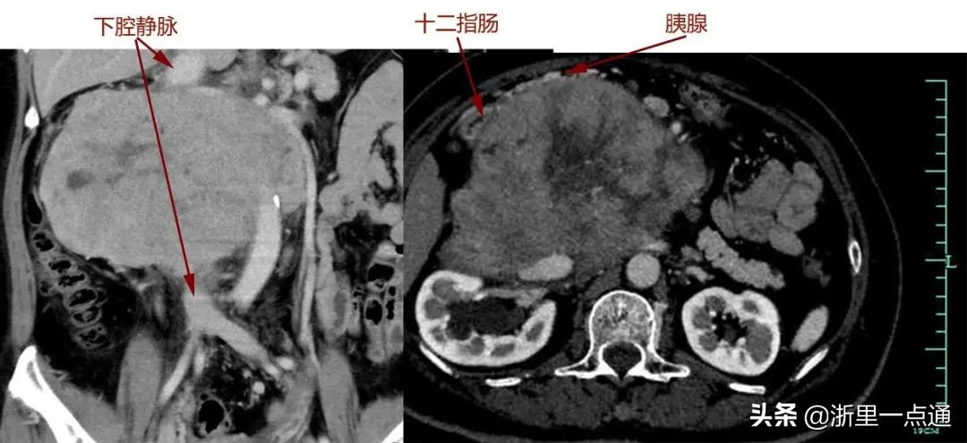 胃口变差，医生从肚子里取出一个“足球”！疫情之下这些事拖不得
