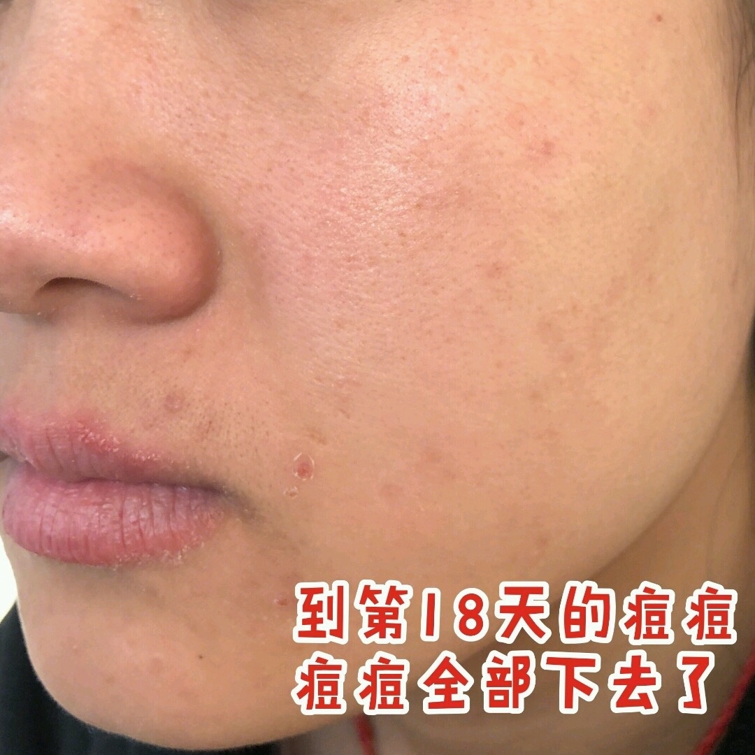 真实有效的几款祛痘印神器,祛痘印最有效的方法排名