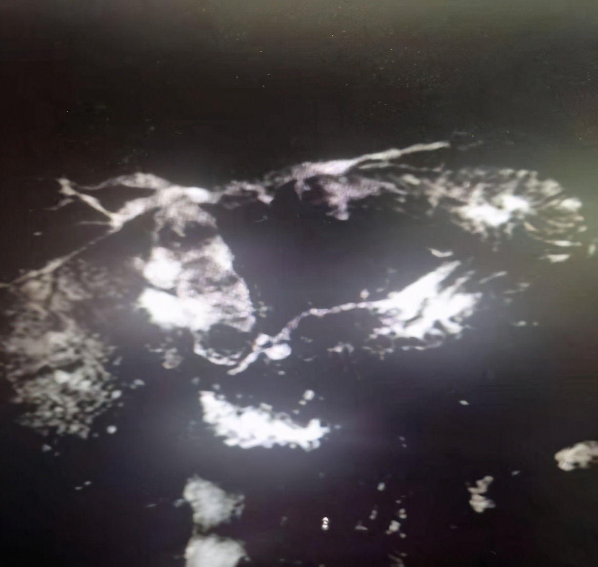 精益求精镜亦求净哈医大一院消化内科ERCP下取净胆管内2.5cm巨型结石