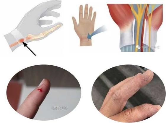 防治腱鞘炎最好的动作,预防腱鞘炎的关键有哪些