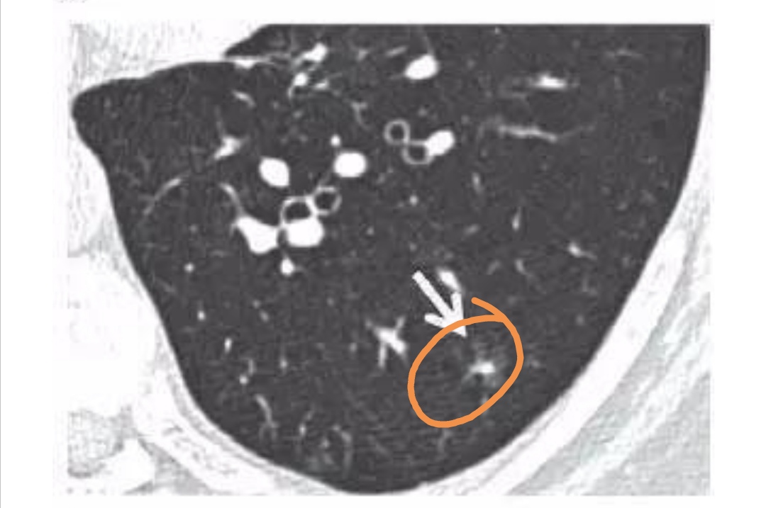 肺小结节4mm半年会不会发展成肺癌,两肺多发小结节是肺癌的前兆吗