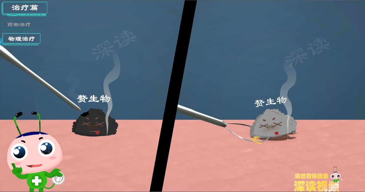 液氮冷冻治疗尖锐疣疼吗 (液氮冷冻治疗尖锐疣几天掉)