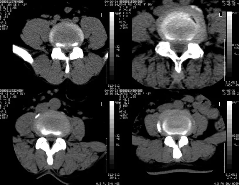 颈椎腰椎疾病ct及mri诊断,腰椎ct可以发现肠部病变吗