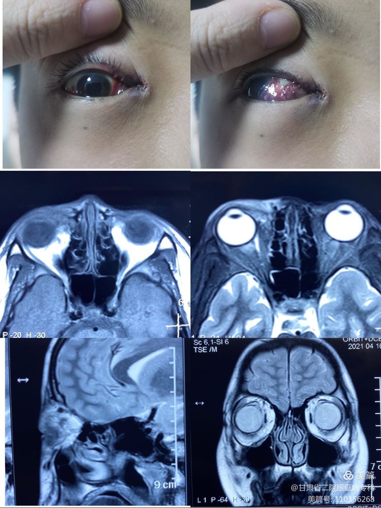 眼眶血管畸形介入治疗多少钱,眼眶血管畸形手术