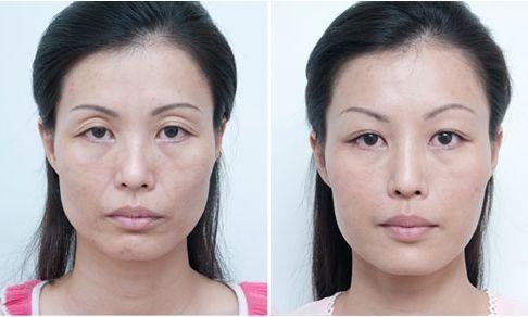 中国人去泰国打美白针,泰国美白针真实事件