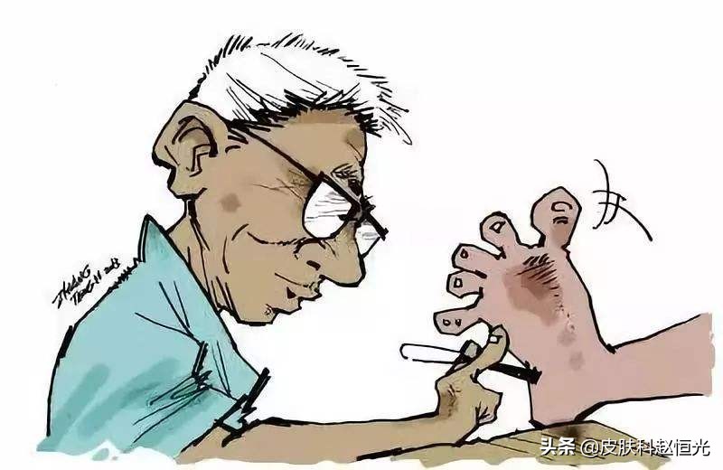 怎么预防脚上的灰指甲传染手上,灰指甲传染率高及时处理避免扩散