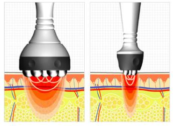 热玛吉提拉紧致皮肤的5个原理,热玛吉光子嫩肤真实感受分享