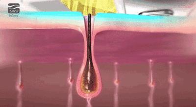 身体皮肤护理去痘印,身体保湿祛鸡皮肤