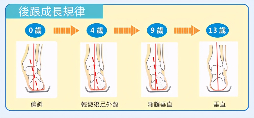 儿童x型腿大小腿怎么纠正,儿童小腿外翻腿型