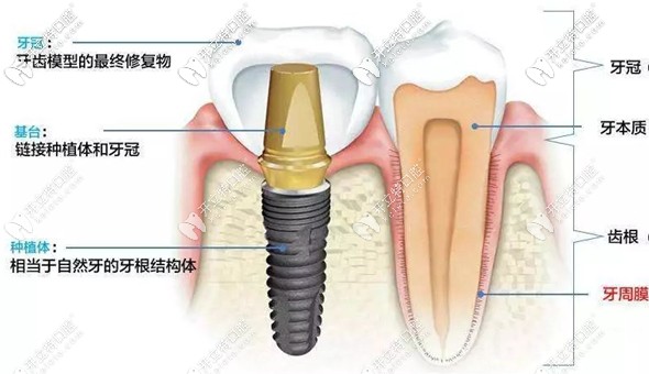 苏州口腔医院种牙价目表,2022苏州种植牙齿价格