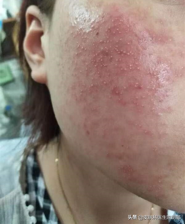 玫瑰痤疮别名酒糟鼻怎么治疗,玫瑰痤疮酒糟鼻怎么治啊