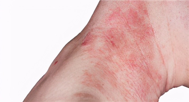 怎么减少挠痒的痒感,夏季过敏性皮炎痒了能挠吗