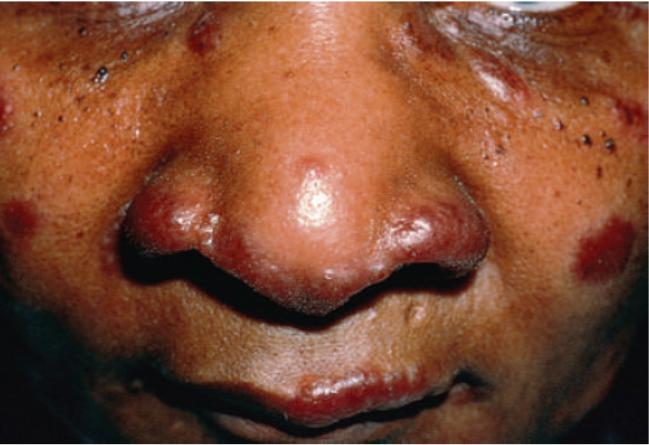 结节病关节痛眼睛模糊,结节病引起的关节炎