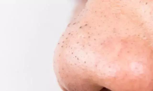 人人都会长黑头吗,好多人都长黑头吗