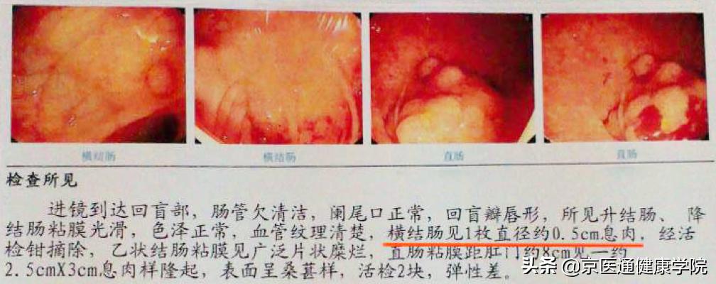 升结肠0.4息肉是癌的可能性是多少,胃体多发息肉0.2-0.4是癌吗