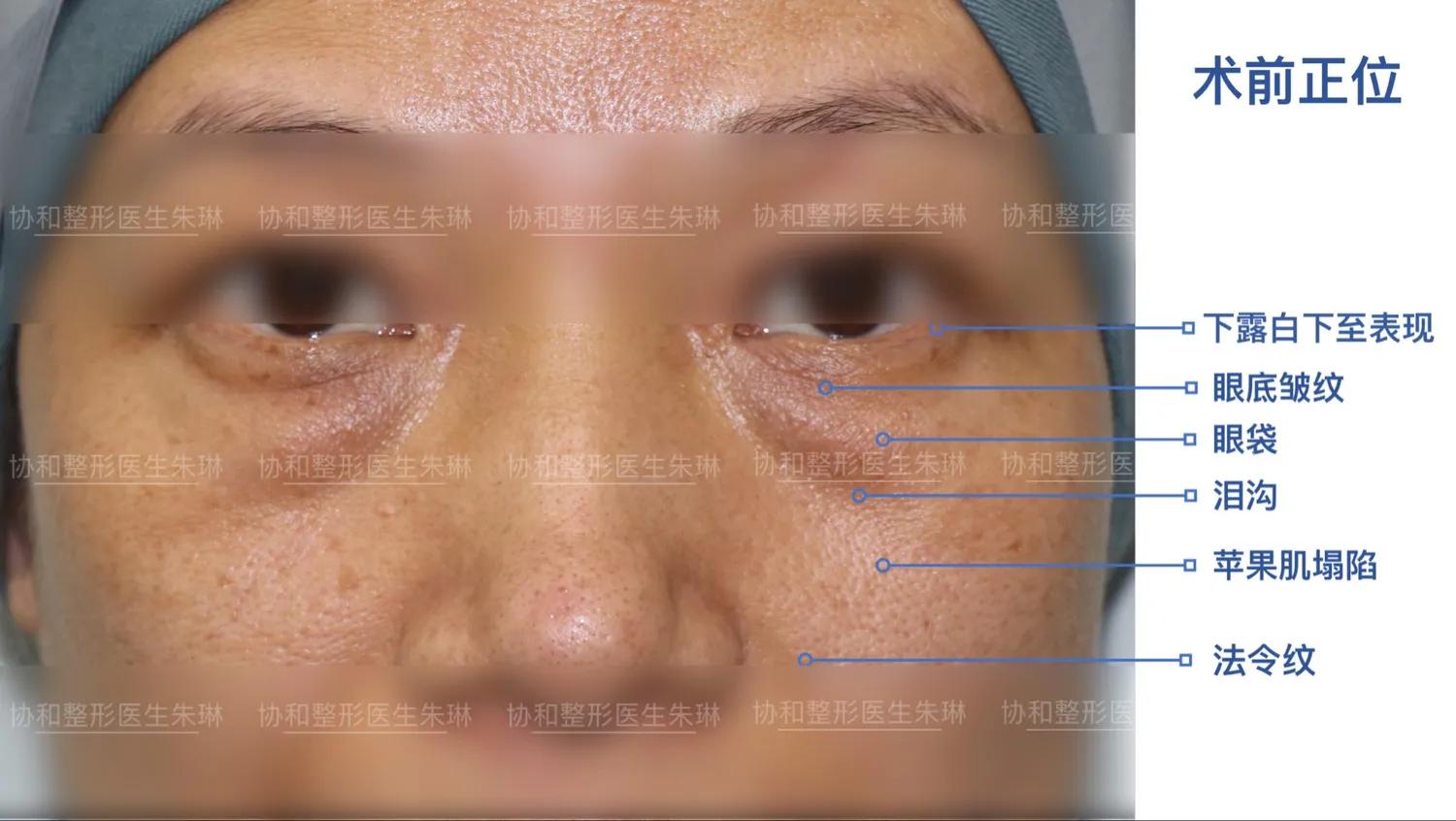 外切眼袋消肿食谱,外切眼袋20天效果图