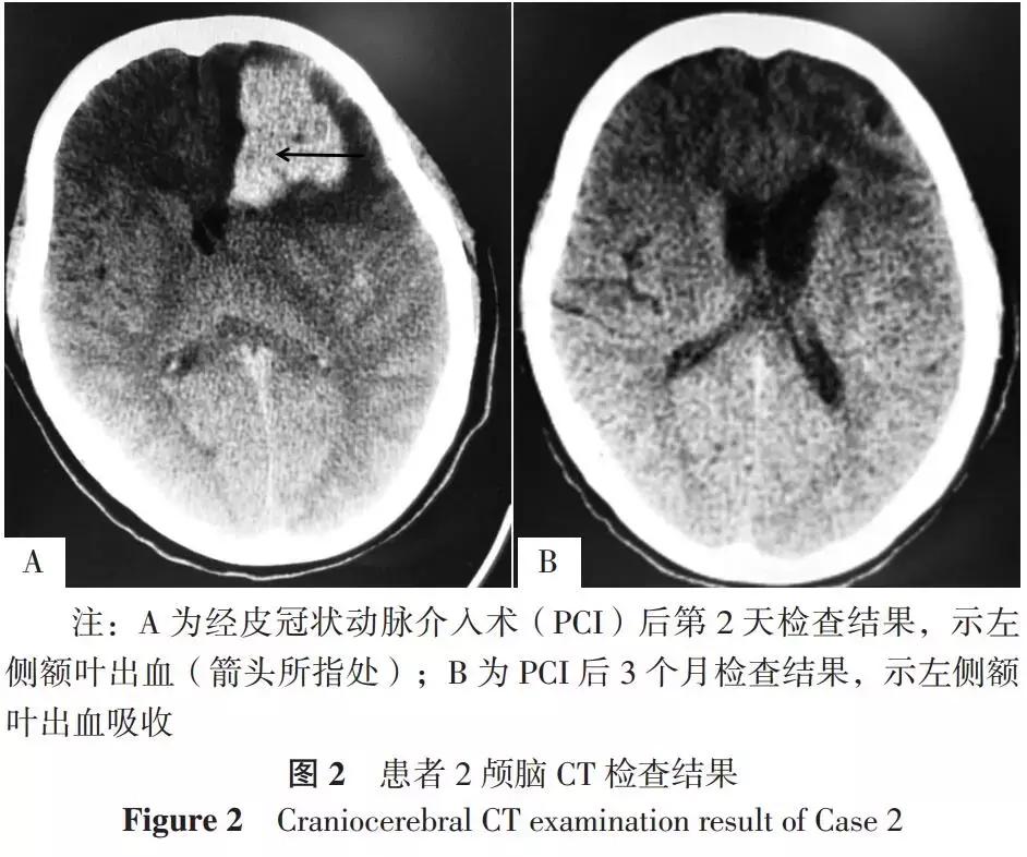 pci术后脑出血症状,脑出血案例分享