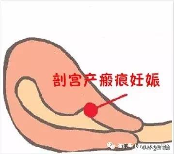 怀孕能做阴超吗,怀孕能做什么运动