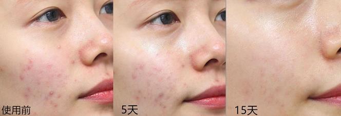 悦诗风吟祛痘小白瓶,悦诗风吟小白管祛痘测评