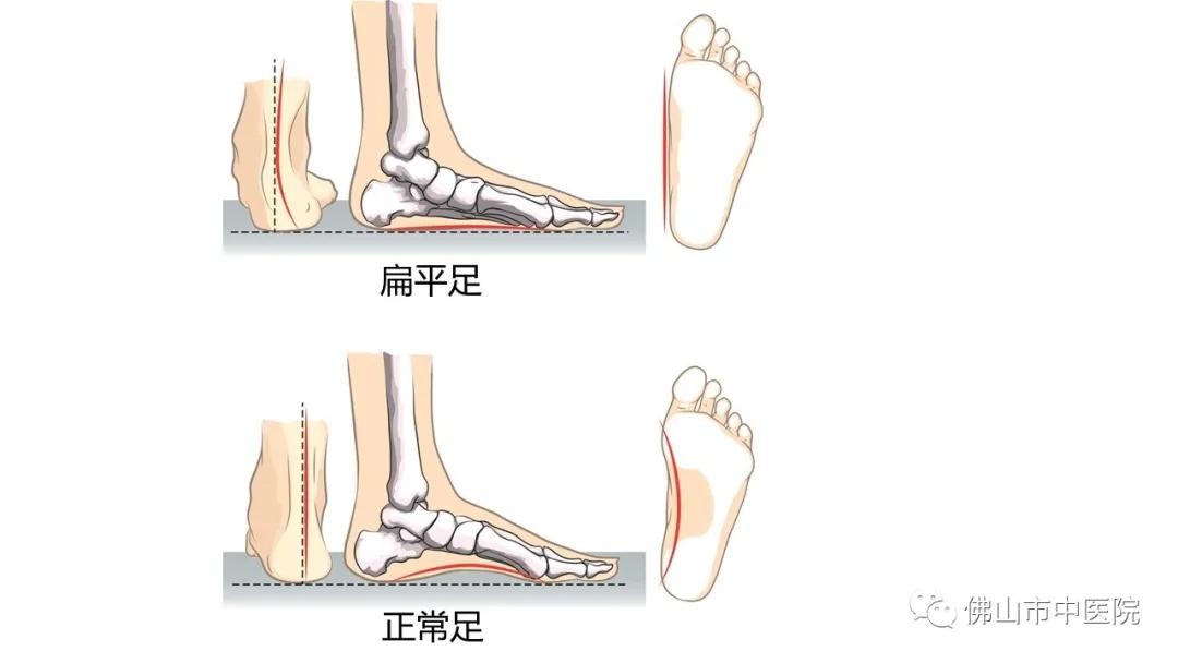 儿童扁平足的矫正训练,儿童矫正扁平足的最佳锻炼方法