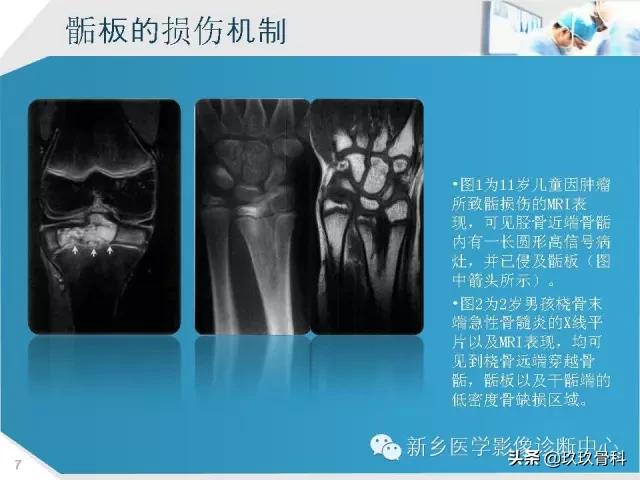 骨骺损伤x线表现,骨骺损伤磁共振表现