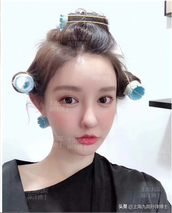 双眼皮修复眼角出现多层疤痕,医生推荐的双眼皮术后祛疤