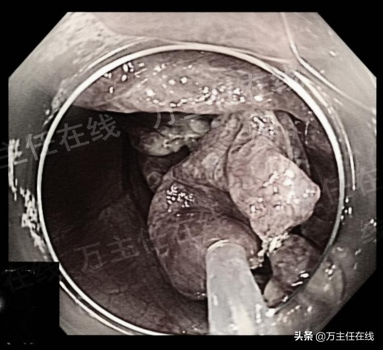 消化内科肝脏手术,肝部囊肿切除手术