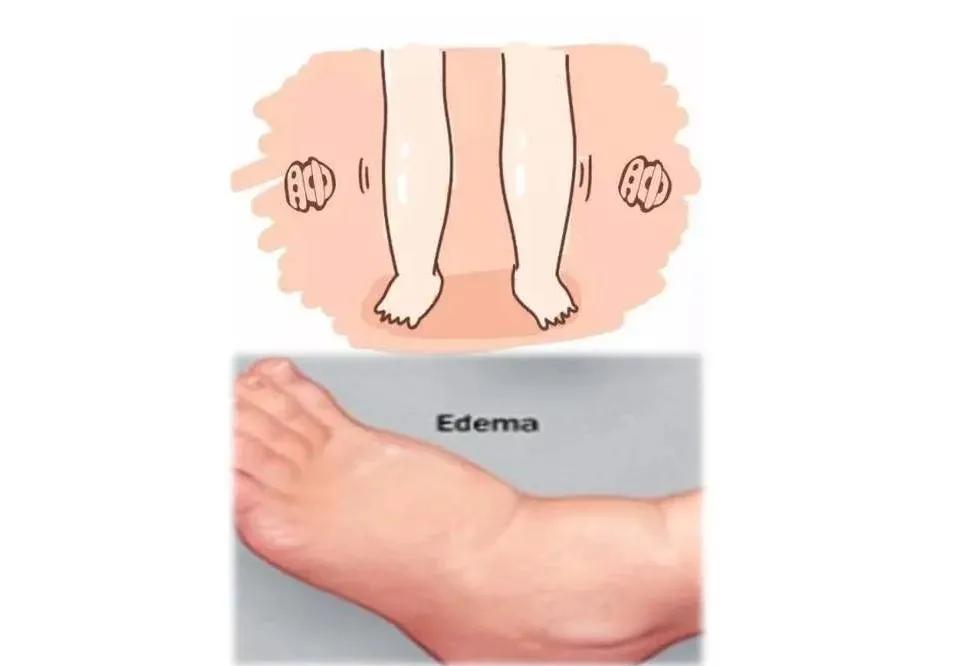 地平类降压药会引起水肿吗,地平类降压药引起的水肿怎么治