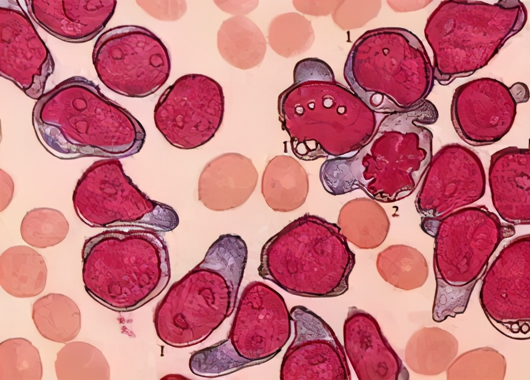 乳腺癌化疗后不良反应多久消失,乳腺癌化疗常见的不良反应及护理