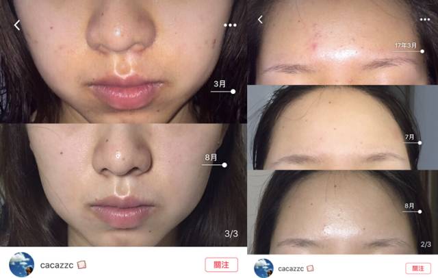 烂脸适合的护肤水,烂脸最好用的护肤品