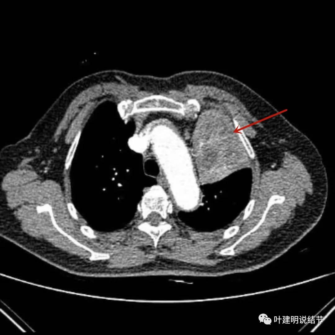 高龄肺癌靶向治疗效果,高龄老人肺癌早期适合放疗吗