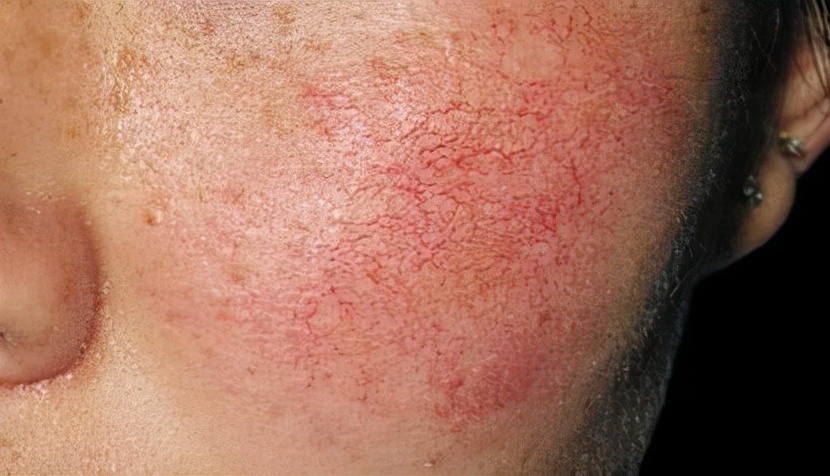 脸上的红血丝怎么祛除,脸上有红血丝怎么办最有效的方法